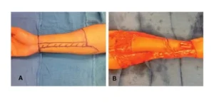 radial forearm flap