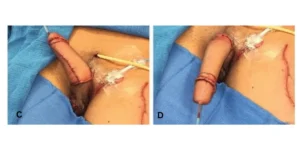 penis phalloplasty results