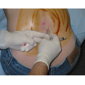 spinal anesthesia for cesarean delivery